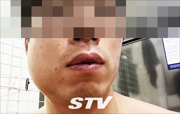 폭행 당일 피해자 A씨의 얼굴 사진. 코뼈가 부러지고 볼이 부었다. 사진-피해자 A씨.